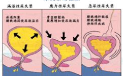 尿失禁的原因,成因、类型与防治策略”