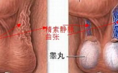 精索静脉曲张的症状,男性健康警示，揭秘常见症状与影响