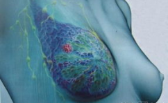 乳腺癌的发病原因,多因素交织下的健康挑战