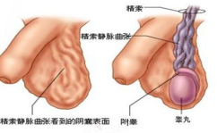 精索静脉曲张的症状,男性健康警示，揭秘常见症状与影响